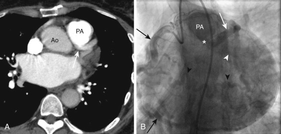 FIG 58-25, ALCAPA in a 53-year-old woman with chest pain. A, Axial image from a CT pulmonary angiogram shows the left main coronary artery (white arrow ) arising from the pulmonary artery (PA), consistent with ALCAPA. Note that attenuation in the left main coronary artery is very similar to that of the aorta (Ao) and much less dense than attenuation of the PA, suggesting flow from the aorta through collaterals into the left main. B, Coronary angiogram with a right coronary artery (RCA) injection shows a diffusely dilated RCA (black arrows) and acute marginal branch (black arrowheads), suggestive of a long-standing fistula. Flow from these dilated vessels fills the LCx (white arrowhead), LAD (white arrow), and left main (white star) via retrograde flow. The blood then drains into the PA. Owing to the presence of collateral circulation, the patient was able to survive into adulthood with this congenital abnormality.
