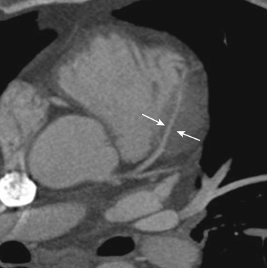 FIG 58-26, Myocardial bridging. Axial oblique image from a coronary CTA shows the mid-LAD diving into the left ventricular myocardium (white arrows), consistent with a myocardial bridge. This is a common incidental finding and of little clinical significance in the vast majority of patients.