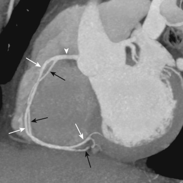 FIG 58-27, Split RCA in a 23-year-old man. C-view of the right coronary artery from a coronary CTA shows a single RCA proximally (white arrowhead). However, the RCA splits into two parallel vessels (black and white arrows), one of which terminates as the PDA (black arrows) and the other of which terminates as the proximal LV branch (white arrows) . This is a very rare anomaly and is benign.