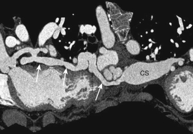 FIG 58-28, Coronary artery fistula. Curved MPR image from a coronary CTA shows a diffusely enlarged LCx (white arrows) that drains into the coronary sinus (CS), consistent with a fistula. This was an incidental finding.