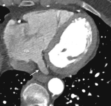 FIG 58-29, Coronary sinus. The coronary sinus (arrow) provides drainage for most of the cardiac veins and drains into the right atrium (RA).