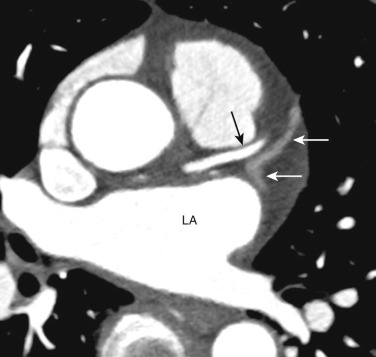 FIG 58-30, Great cardiac vein. The great cardiac vein (long white arrows) courses alongside the LAD (black arrow) and drains into the coronary sinus. LA, left atrium.