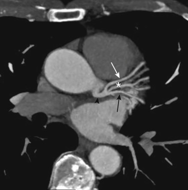 FIG 58-3, Ramus intermedius. The left main (black arrowhead) trifurcates into the LAD (white arrow), LCx (black arrow), and ramus intermedius branches (white star). A ramus intermedius is present in 20% to 30% of the population.