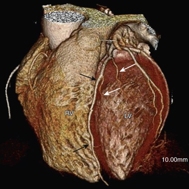 FIG 58-4, LAD anatomy. Volume-rendered image of the anterior heart from a coronary CTA shows the LAD (black arrows) coursing in the anterior interventricular sinus or groove between the right ventricle (RV) and left ventricle (LV). Diagonal branches (white arrows) arise from the lateral aspect of the LAD to supply the anterior lateral aspect of the LV.