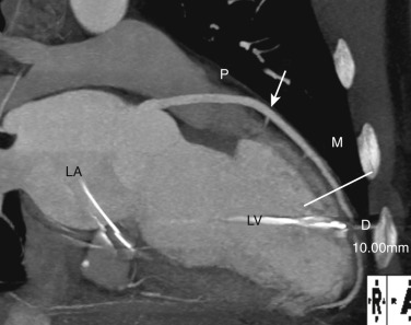 FIG 58-5, LAD segmentation. Two-chamber MIP view of the LAD from a coronary CTA shows the vessel coursing over the anterior walls of the left ventricle (LV). The LAD is divided into three segments. The proximal LAD (P) is defined as the portion of the LAD from its origin to the ostium of the first large septal branch (white arrow) or diagonal branch, whichever arises first. The definition of the mid-LAD (M) is defined as the end of the proximal LAD to half the distance to the LV apex (white line). The distal LAD (D) is defined as the end of the mid-LAD to the termination of the LAD. LA, left atrium.