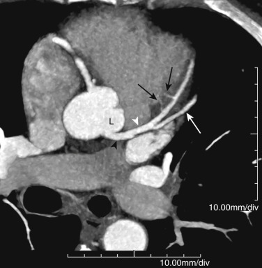 FIG 58-6, Septal and diagonal branches of the LAD. Double oblique axial MIP image from a coronary CTA shows the left main coronary artery (black arrowhead) arising from the left sinus of Valsalva (L). The left main bifurcates into the LAD (white arrowhead) and LCx (not shown in plane). The lateral branches of the LAD are diagonal vessels (white arrow) that supply the anterolateral aspect of the LV. The smaller septal arteries (black arrows) supply the anteroseptal portion of the LV.