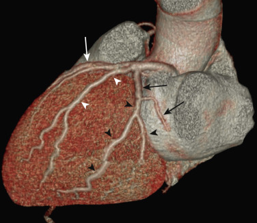 FIG 58-7, LCx anatomy. Volume-rendered image from a coronary CTA looking at the lateral aspect of the LV shows the left main coronary artery trifurcating into the LAD (white arrow), ramus intermedius (white arrowheads), and LCx (black arrows). The LCx courses in the groove between the left atrium and ventricle and gives rise to obtuse marginal braches (black arrowheads) that supply the inferolateral aspect of the LV. In right-dominant patients, the LCx becomes small in size near the inferolateral aspect of the LV distal to the ostia of the last obtuse marginal branch.