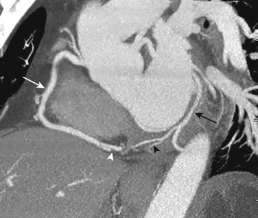 FIG 58-8, Coronary artery codominance. Coronal oblique MIP image through the AV grooves from a coronary CTA shows the right coronary artery giving rise to the posterior descending coronary artery. The distal LCx (black arrow) is a large vessel and gives rise to the posterior ventricular branch (black arrowhead), consistent with a codominant system. In most patients who are right dominant, the distal LCx will be diminutive in size toward the inferior aspect of the LV.