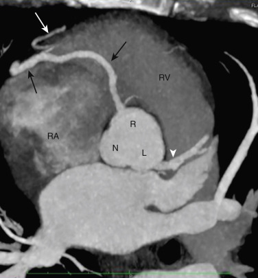 FIG 58-9, Right coronary artery anatomy. Axial oblique view transverse to the aortic sinuses from a coronary CTA shows the right coronary artery (RCA, black arrows ) arising from the right sinus of Valsalva (R) and the left main coronary artery (white arrowhead) arising from the left sinus (L). No coronary artery arises from the noncoronary sinus (N). The RCA courses in the right AV groove between the right atrium (RA) and right ventricle (RV). Acute marginal branches (white arrow) of the right ventricle arise anteriorly and supply to the anterior free wall of the RV.