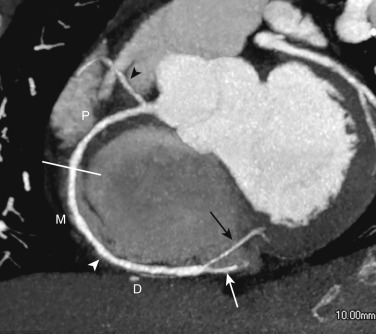 FIG 58-10, Right coronary artery (RCA) anatomy. C-view of RCA from a coronary CTA shows its division into three territories. The proximal RCA (P) is defined as the ostium of the RCA to half the distance to the acute margin of the heart (white arrowhead). The mid-RCA (M) is defined as the end of the proximal RCA to the acute margin of the heart, and the distal RCA (D) is defined as the end of the mid-RCA to the origin of the posterior descending artery (PDA, white arrow ). The posterior ventricular branch (black arrow) courses over the PDA in this patient with right dominance.