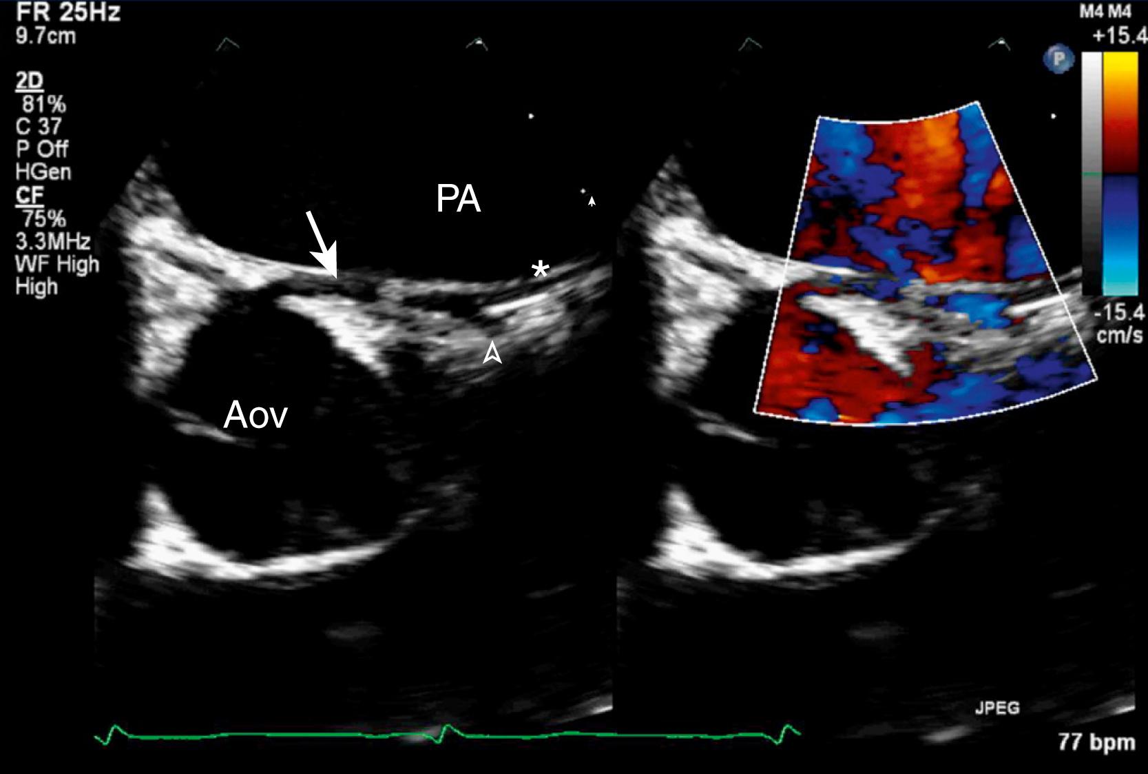 Figure 47.2, Parasternal short-axis view at the level of the aortic valve, clockwise rotated. The left coronary artery (CA) is seen arising from the right sinus of Valsalva with an interarterial course. The arrow is pointing at the anomalous left main CA, the asterisk indicates the left anterior descending CA, and the caret indicates the left circumflex CA. Aov, Aortic valve; PA, pulmonary artery. (See corresponding Video 47.2 .)