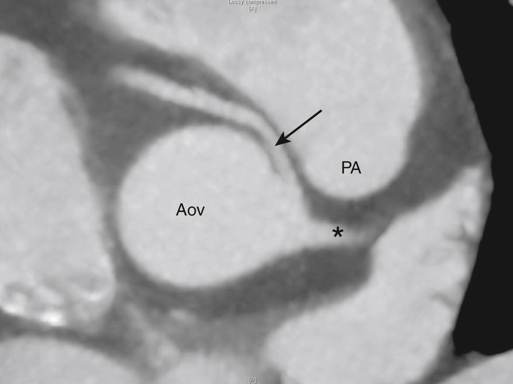 Figure 47.3, Coronary computed tomography scan demonstrates an anomalous right coronary artery (CA) arising from the left sinus of Valsalva with an interarterial course. The arrow is pointing at the anomalous right CA, and the asterisk indicates the left main CA. Aov, Aortic valve; PA, pulmonary artery.