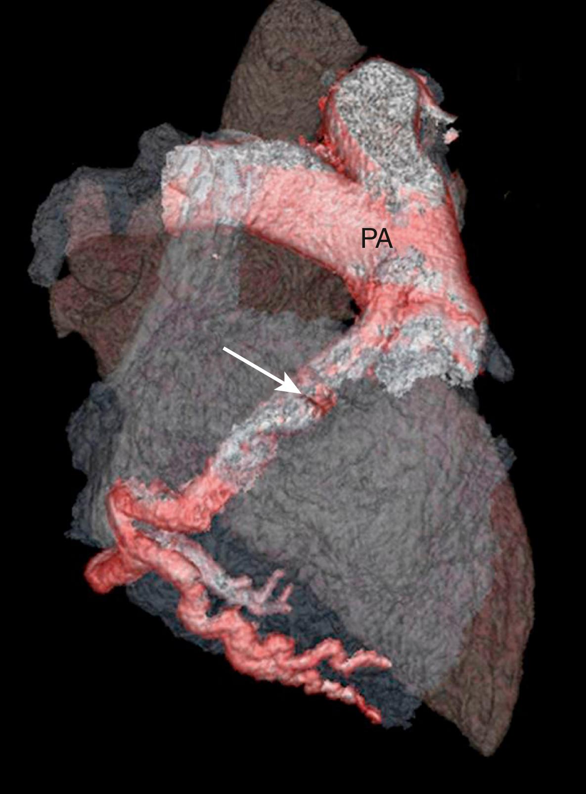 Figure 47.4, Volume-rendered computer computed showing scan a dilated anomalous right coronary artery arising from the pulmonary artery (ARCAPA). The arrow points at the ARCAPA. PA, Pulmonary artery.