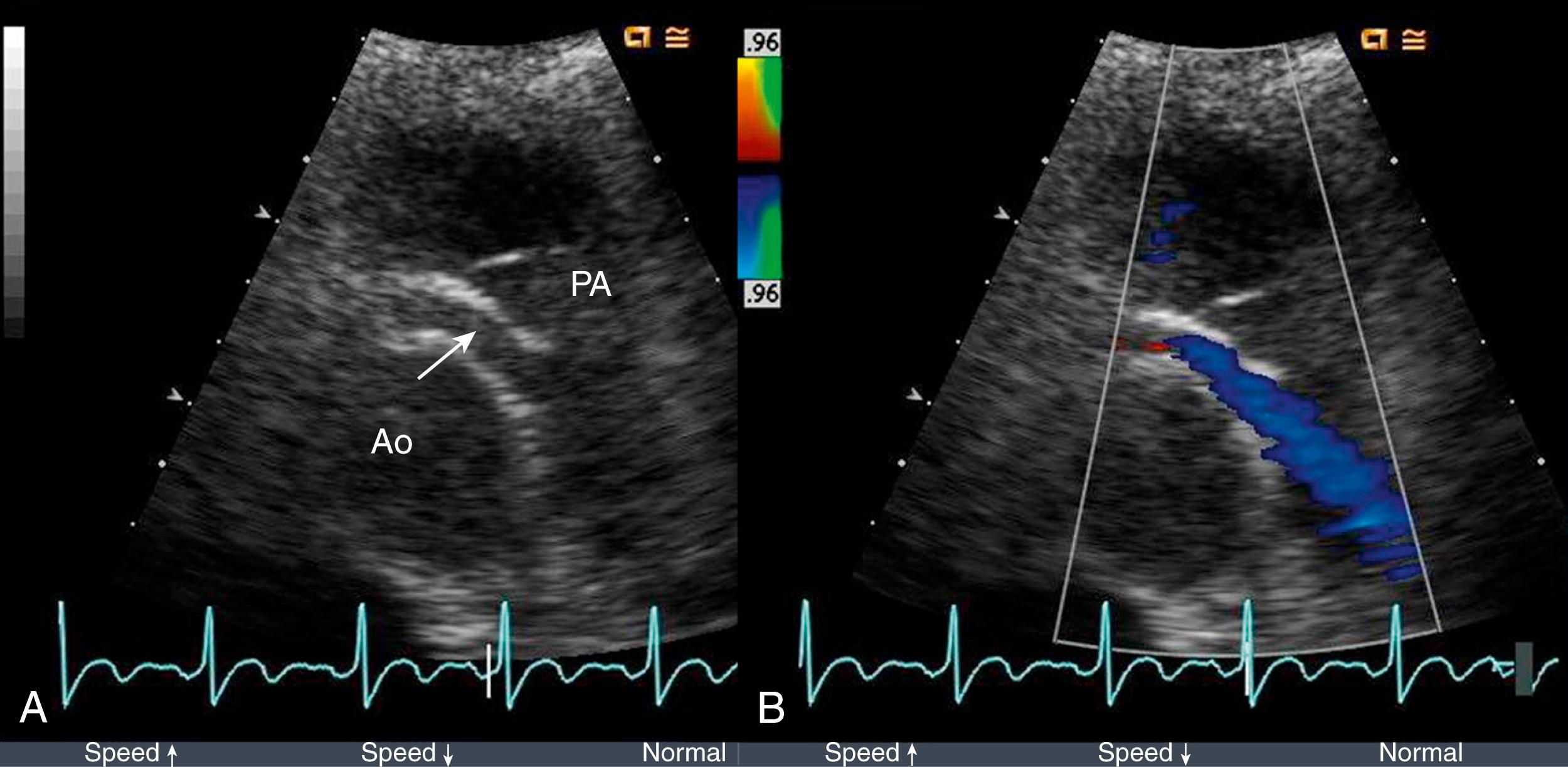 Figure 47.5, A, Two-dimensional and color Doppler echocardiography at the level of the pulmonary artery (PA) showing anomalous right coronary artery arising from the pulmonary artery (ARCAPA). B, Note the blue diastolic coronary flow into the pulmonary artery demonstrating that the ARCAPA is perfused retrograde from collaterals from the left coronary artery and drains into the pulmonary artery. Ao, Aorta. (See Video 47.5 .)