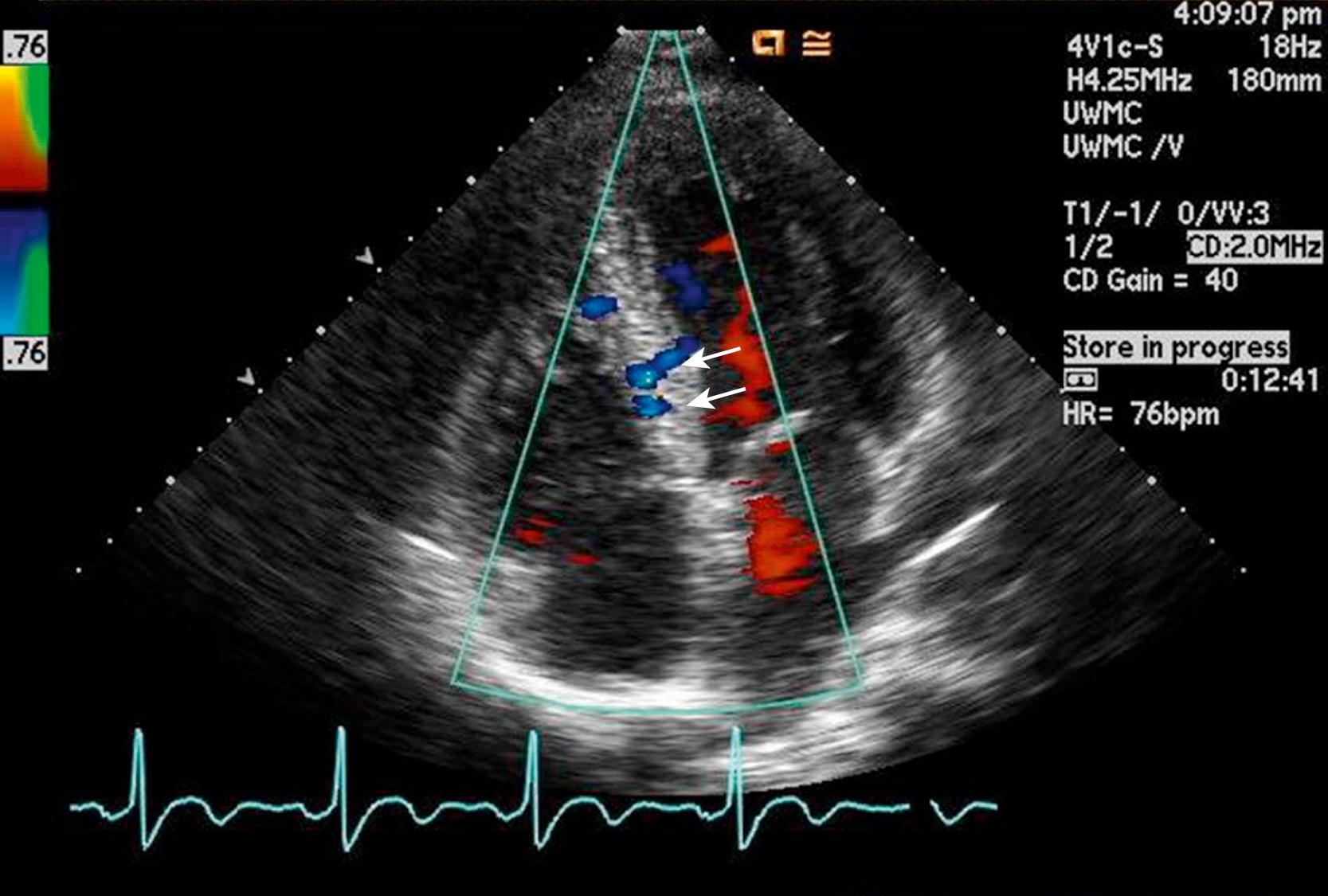 Figure 47.6, Apical four-chamber view with color Doppler in a patient with anomalous right coronary artery from the pulmonary artery (ARCAPA). Arrows point to diastolic color flow across the ventricular septum from dilated coronary collaterals. These can be distinguished from ventricular septal defects by their low-velocity diastolic flow. (See Video 47.6 .)