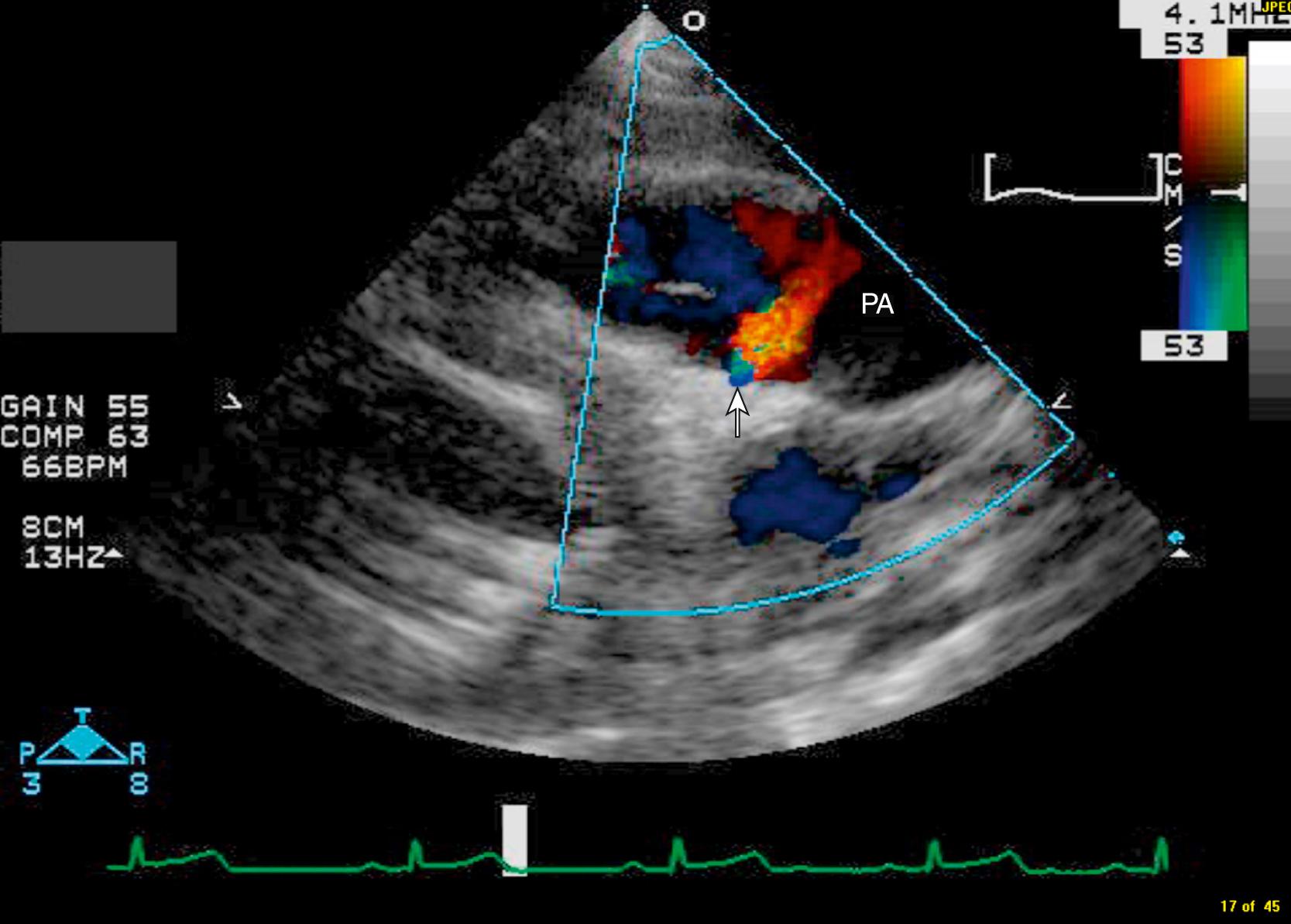 Figure 47.7, Parasternal long-axis view with color Doppler in a patient with anomalous right coronary artery from the pulmonary artery (ARCAPA). Arrows point to diastolic color flow across the ventricular septum from dilated coronary collaterals. These can be distinguished from ventricular septal defects by their low-velocity diastolic flow. PA, Pulmonary artery. (See Video 47.7A , Video 47.7B .)