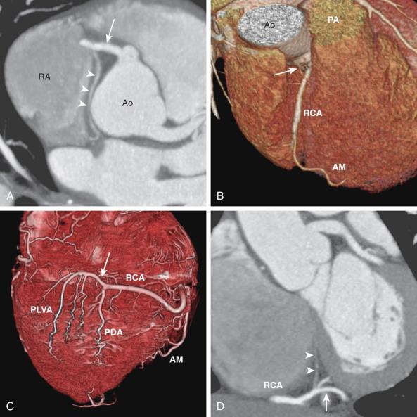 Figure 77.2, Major branches of the normal right coronary artery (RCA) .