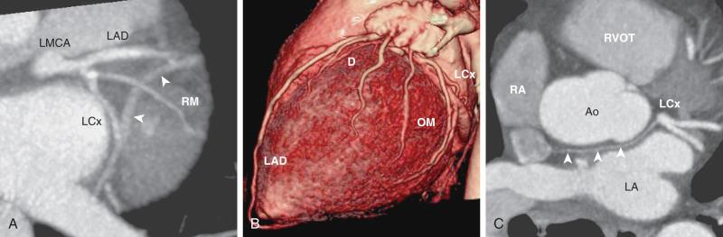 Figure 77.3, Major branches of the normal left main coronary artery (LMCA) .