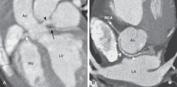 e-Figure 77.4, Common benign variants of the coronary arteries.