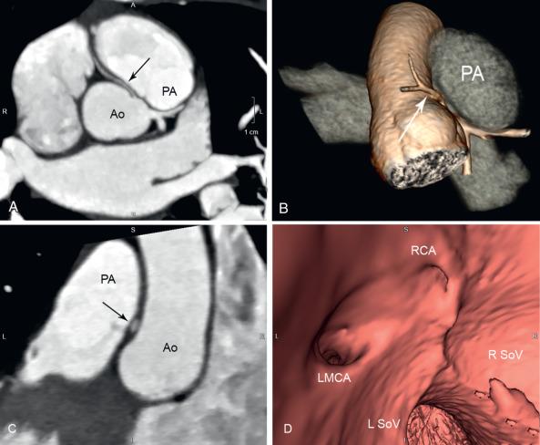 Figure 77.5, Anomalous right coronary artery with an interarterial course.