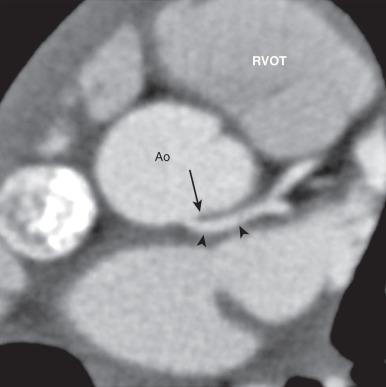 e-Figure 77.6, CCTA of an anomalous left main coronary artery (LMCA) from the noncoronary sinus.