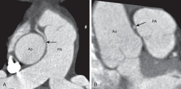 Figure 77.7, CCTA of an intramural right coronary artery (RCA) arising from the left sinus of Valsalva in an 8-year-old girl.