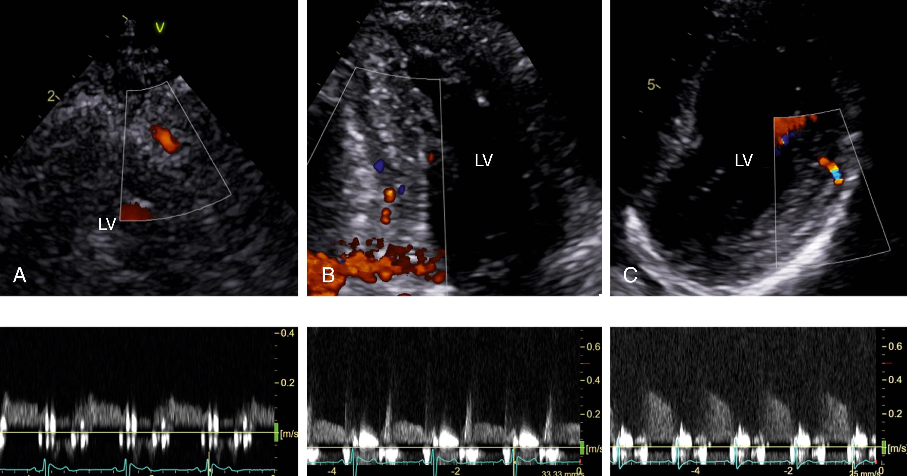 Figure 48.1, Coronary flow recordings. A, Coronary flow in the distal portion of the left anterior descending coronary artery. B, Coronary flow in the posterior descending coronary artery. This is an off-axis two-chamber view. C, Coronary flow in the left circumflex coronary artery. This is an off-axis four-chamber view. LV, Left ventricle. (See Video 48.1A , Video 48.1B , Video 48.1C .)