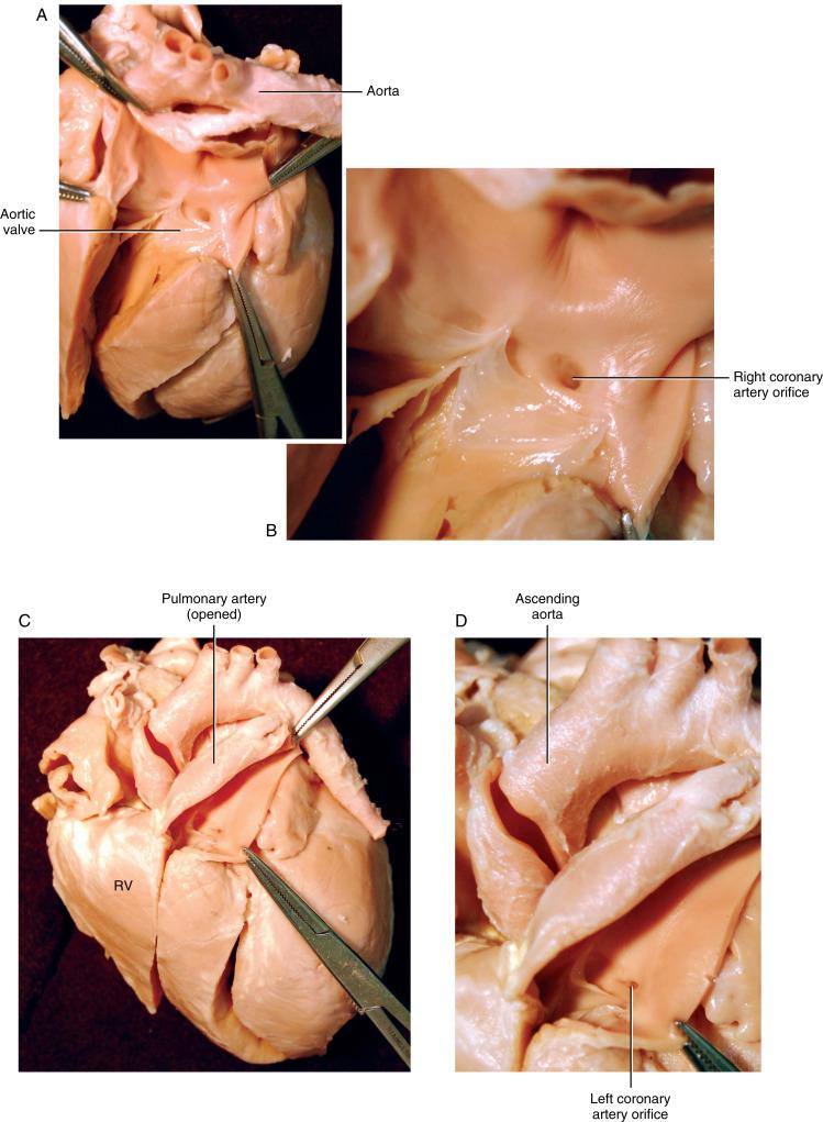 Figure 25-1, A Anomalous origin of left coronary artery from pulmonary artery. The specimen is opened to the outlet portion of the left ventricle and the aortic root through the noncoronary sinus of Valsalva. The ascending aorta and arch (identified by its aortic branches) and the upper portion of the descending aorta are demonstrated. There is only one coronary artery orifice seen in the aortic root. B Anomalous origin of left coronary artery from pulmonary artery, magnified view. The single large coronary artery orifice is identified as the right coronary artery. There is no coronary artery orifice in the left coronary sinus. The noncoronary sinus aorta has been divided along with the valve, and there is no identifiable coronary artery in this sinus either. C Anomalous origin of left coronary artery from pulmonary artery. The right ventricle (RV) is opened anteriorly into the anterior wall of the pulmonary artery. The small left coronary artery orifice is identified on the posterior aspect of the pulmonary artery. D Anomalous origin of left coronary artery from pulmonary artery, magnified view. The left coronary artery originates from the posterior sinus of Valsalva of the pulmonary artery. The ascending aorta and arch are seen emerging from behind the pulmonary artery. The distance from the origin of the left coronary artery to the ascending aorta can be appreciated by studying the dimensional aspects of this image. E Anomalous origin of left coronary artery from pulmonary artery, operative view. This photograph shows dilation of the right coronary artery and dilated branches forming the collateral circulation to the left coronary artery. F Anomalous origin of left coronary artery from pulmonary artery, operative view. This photograph in another patient shows even more pronounced dilation of the right coronary artery, compensating for the pulmonary artery origin of the left coronary artery. G Coronary artery–to–cardiac chamber fistula, operative view. This photograph is from a patient with a right coronary artery fistula to the right ventricle. The pronounced dilation of the right coronary artery is comparable to that seen in Figure 25-1 , F . The difference is that the dilation is confined to the main channel of the right coronary artery; the branch arteries are normal. H Coronary artery–to–cardiac chamber fistula, operative view. The exposure is through the right atrium. The fistulous opening of the right coronary artery to the right ventricle is located just below the atrioventricular groove and the septal leaflet of the tricuspid valve.