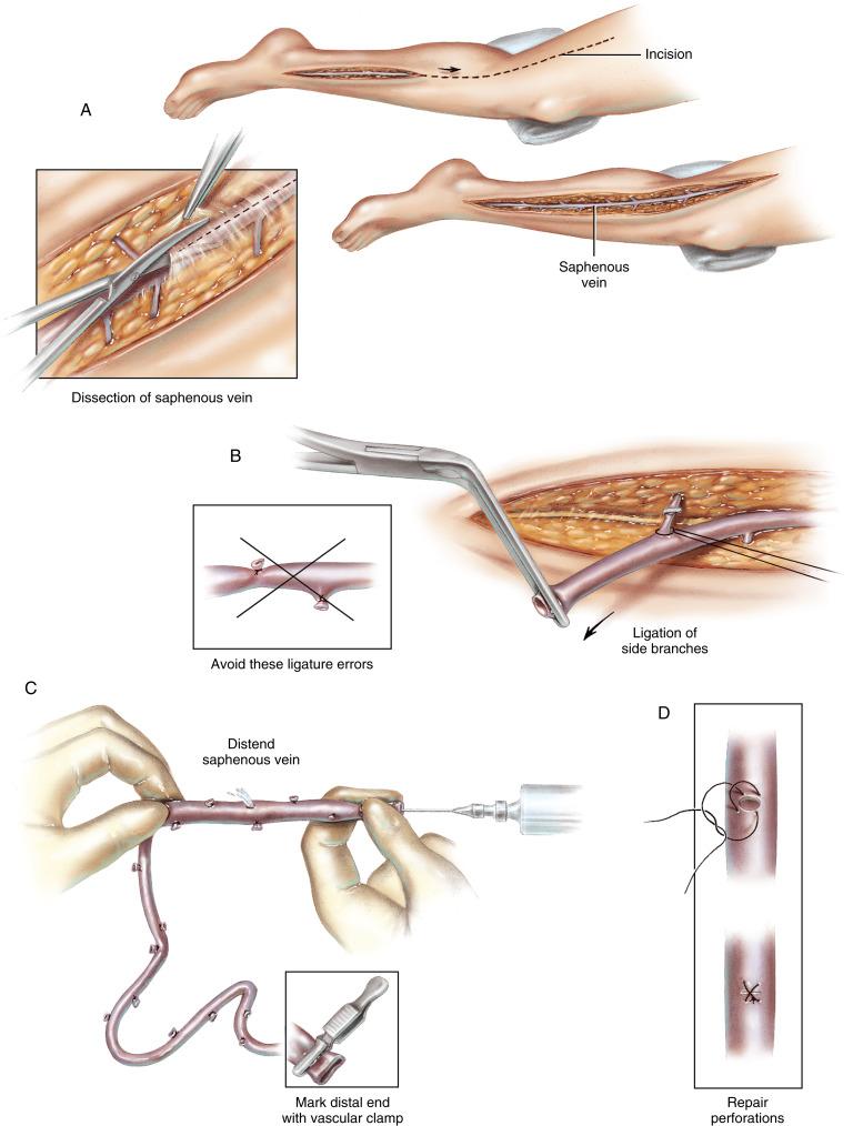 Figure 36-2, A While the midsternal incision is made and preparations for cardiopulmonary bypass are under way, a simultaneous incision is made in the left leg over the course of the greater saphenous vein. The leg is abducted and rotated laterally by placing a roll under the knee. The foot is draped so that the ankle is exposed. With the leg in the dependent position, the vein becomes distended, allowing its course to be easily marked on the skin with a fine needle or marking pen before making the incision. The skin is opened sharply down to the level of the saphenous vein. Beginning at the ankle—to ensure a constant location anterior to the medial malleolus and easy identification of the vein—the connective tissue overlying the vein is removed. Curved Mayo scissors are ideal for this dissection. These scissors can be placed easily and safely into the plane between the connective tissue and adventitia of the saphenous vein, allowing the plane to be opened without injuring the vein. The scissors are opened perpendicular to the vein to lift the connective tissue from the top of the vein. Lateral blunt dissection should be avoided to prevent tearing of the side branches. The dissection must be limited to tissues directly over the vein. The scissors are then used to divide the connective tissue and expose the vein. Most of the side branches of the vein come into view without any lateral dissection. The entire length of the vein should be exposed before attempting to remove any of it. For a single segment of vein graft, the incision extends from the ankle to the midportion of the leg below the knee. For two grafts, the vein from the ankle to just below the knee is sufficient; for three or more grafts, the vein should be exposed to the midportion of the leg above the knee. B The saphenous vein is ligated at the ankle over the medial malleolus. The vein is divided, and an angled peripheral vascular clamp is applied to the end to serve as a handle for retraction. For ease of dissection, firm upward retraction is applied to expose the posterior connective tissue and the side branches of the vein as they are encountered. Connective tissue must be cleanly removed from each branch’s junction with the main vein so that the branch can be accurately ligated. A ligature of 4/0 silk is passed on a curved hemostat around the branch. The branch is tied precisely on the side of the saphenous vein. A small hemoclip is applied to the branch at the tissue level, and the vein branch is divided. Ligatures placed too close to the saphenous vein or that include any connective tissue not completely removed from the junction will distort and narrow the saphenous vein as its adventitia is drawn into the ligature. If the ligatures are placed away from the side of the vein, thereby leaving a length of branch between the vein and the ligatures, there is the potential for thrombus formation where stasis occurs. These errors in technique should be avoided. C The desired length of saphenous vein is removed and prepared for bypass grafting by gentle distension using heparinized isotonic electrolyte solution. Some surgeons prefer to use the patient’s blood to distend the vein. The addition of papaverine to the solution is optional. A Dietrich vascular clamp is placed on the distal end of the saphenous vein as a matter of routine to ensure proper orientation of the valves. As the vein is distended, side branches that have not been ligated are identified. A small hemostat can be applied, and the branch can simply be ligated with 4/0 silk suture or a hemoclip. D When the branch consists of a hole in the vein, the site is closed by a double-loop stitch of 7/0 polypropylene. This technique provides the most accurate and secure closure of the vein perforation and results in the least chance of vein distortion by the pulling in of adventitial connective tissue. The right coronary system, anterior descending coronary system, and circumflex coronary system can be bypassed using individual grafts for each system. When more than one anastomosis is required in any of the three systems, sequential graft techniques are used. Alternatively, various combinations of graft sequences can be employed to conserve the length of vein required to accomplish complete revascularization of the coronary arteries.