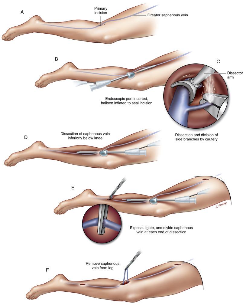 Figure 36-3, A A small incision is made on the medial aspect of the knee. Direct or endoscopic visualization is used to locate the greater saphenous vein, which can be encircled with a vascular snare if necessary. Prior to inserting the endoscopic system, intravenous heparin is administered to prevent intraluminal clot. B The endoscopic port is inserted into the incision. The balloon on the port is inflated to maintain the seal if necessary. Continuous carbon dioxide insufflation is used to expand the tunnel and subcutaneous tissues for better visualization. C A tunnel is created along the course of the saphenous vein in the thigh by gradually advancing the cone of the dissector under videoscopic guidance. The vein and side branches are freed from the subcutaneous tissue anteriorly, posteriorly, and bilaterally. The side branches are then cauterized and divided to free the vein within the tunnel in the thigh. D A similar tunnel is created along the course of the saphenous vein in the calf by reversing the direction of the endoscopic system within the primary incision. The vein and side branches are freed from the subcutaneous tissue, and the side branches are divided to free the vein within the tunnel in the lower leg. E Using videoscopic guidance, a small stab wound is made through the skin and into the tunnel above the vein at both the proximal and distal ends of the tunnel. The vein is gently retrieved through the stab incision and divided under direct vision. Alternatively, an endoloop can be used to ligate the proximal and distal ends; the vein is then divided with electrocautery. F The entire saphenous vein is removed through the knee incision. The remnants of the side branches are reinforced with fine silk ligatures. A pressure dressing is applied to the leg.