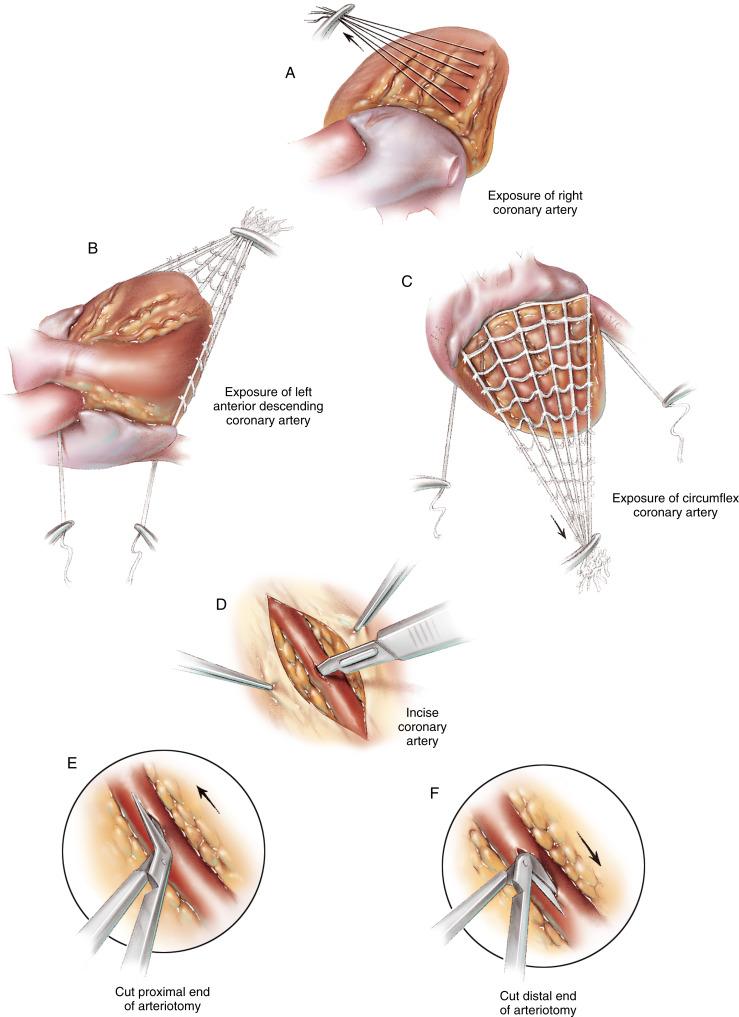 Figure 36-4, A Cardiopulmonary bypass is established using a single cannula (two stage) for venous drainage, with oxygenated blood returned to the ascending aorta through a cannula placed just below the pericardial reflection. The left ventricle is decompressed by a right-angled vent catheter or a pediatric vent catheter passed via the right superior pulmonary vein to the left atrium and left ventricle. The aorta is occluded by a vascular clamp high on the ascending aorta. Revascularization is accomplished during a single aortic occlusion period. Cold cardioplegic solution (blood-based) is injected into the ascending aorta, retrograde through the coronary sinus; alternatively, a combination of antegrade and retrograde perfusion can be used. The myocardium is perfused intermittently during the procedure. Exposure of the coronary arteries for the distal anastomosis of the saphenous vein to the coronary arteries can be accomplished by a number of techniques. The common practice of having an assistant retract the heart under a gauze sponge or with a cotton glove may cause unwanted cardiac trauma. The quality of the exposure depends on the attention of the assistant. Static exposure of the distal right coronary artery and its posterior descending branch can be obtained by placing three or four traction stitches on the acute margin of the heart. One of the stitches should be near the atrioventricular groove. These stitches are held with a hemostat, which is retracted cephalad either by an assistant or by attaching it to a rubber band secured to the drapes. B Exposure of the left coronary branches is accomplished by a net device tied to umbilical tape. The ends of the tape are drawn through the transverse sinus and through an opening below the right inferior pulmonary vein behind the inferior vena cava. The net is placed behind the heart and drawn tight to the atrioventricular groove by right lateral retraction and by securing the tape to hemostats on the right anterior chest wall. Elevating the net and securing the end of it to the left anterior chest wall expose the left anterior descending coronary artery. C By retracting the net to the right and securing it to the right anterior chest wall, the cardiac apex is tipped up, exposing the posterior surface of the left ventricle and providing access to the left circumflex coronary artery. Sections of the net can be removed for improved access to the surface coronary arteries. Incision of the Coronary Artery D The coronary artery is exposed and incised directly through the epicardium, without mobilization. Lateral traction with forceps fixes the coronary artery in place. A No. 15 scalpel is gently stroked on the coronary artery until the lumen is entered. The part of the scalpel blade near the tip is used so that neither the scoring nor the subsequent arteriotomy is too long. Entry of the coronary artery is confirmed by observing cardioplegic solution exiting the artery. Optical magnification (2.5 to 3.5×) is essential for precise and accurate visualization of the coronary artery. E The arteriotomy is extended at each apex using Dietrich coronary artery scissors. The 20- or 45-degree scissors are used to open the artery at the proximal end. The scissors should be placed carefully into the lumen of the artery so that the tips do not damage the intima. The tips of the scissors should never be used to probe the lumen of the coronary artery. The cut should be to the tips of the scissors so that the length of the incision is precisely controlled. Should there be any question about the identification of the actual coronary artery lumen, calibrated coronary probes should be employed judiciously. F The distal end of the arteriotomy is completed in a similar fashion using 130-degree Dietrich scissors. The length of the coronary artery incision should approximate the diameter of the saphenous vein, measuring about 4 to 5 mm. Care should be taken to ensure that the completed arteriotomy extends for the full length of the scoring to avoid potential weakness at the ends of the arteriotomy. End-to-Side Anastomosis: Left-Side Grafts G The distal end of the saphenous vein segment is beveled at a 30- to 45-degree angle, and an adequate length is ensured for its course over the surface of the heart. A 10-stitch anastomosis is constructed using 7/0 polypropylene. Performing the anastomosis in precisely the same fashion in every case ensures a standardized technique and reproducible patency results. Five stitches are taken around the “heel” of the graft: two stitches to the side of the apex of the vein graft and coronary artery, one stitch through the apex, and two stitches on the opposite side of the apex. The graft is held apart from the coronary artery while these stitches are taken. Tension on the suture and retraction of the vein graft to the side provide exposure of the subsequent stitch. The vein graft is held by fine forceps at the side so that the intima at the tip is not injured. Suturing for left-side grafts is performed clockwise on the vein and counterclockwise on the artery. H The suture loops are drawn up, and the suture is pulled straight through to prevent a purse-string effect. The ends of the suture provide lateral traction on the coronary artery for exposure of the distal apex of the coronary arteriotomy. I Five stitches are taken around the “toe” of the graft, with the third stitch placed precisely at the apex of the coronary arteriotomy. Loops of the five sutures are left lax for exposure of the distal portion of the anastomosis. For the proper wagon-wheel effect, the needle direction is changed after the apex stitch is placed. Retraction of the vein graft and opposing traction on the epicardium expose the intima of the coronary artery. The ends of the sutures are tied precisely with tension to approximate the tissue without causing a purse-string effect. End-to-Side Anastomosis: Right-Side Grafts J The arteriotomy in the right coronary artery is generally made in the distal portion near the takeoff of the posterior descending coronary artery or in the posterior descending coronary artery itself as it courses along the posterior aspect of the ventricular septum. With right coronary artery grafts, it is usually easier to place the initial five stitches around the toe of the graft. Careful orientation of the graft prevents confusion. Stitches are placed around the toe of the graft in a counterclockwise fashion and around the distal end of the coronary arteriotomy in a clockwise fashion. The graft is held by fine forceps at the side. Retraction of the graft and suture tension help achieve exposure of the apex of the coronary arteriotomy. Suture loops are drawn up to approximate the graft to the artery and to provide lateral traction on the coronary arteriotomy. K The vein graft is retracted inferiorly with forceps to expose the proximal end of the coronary arteriotomy. Five stitches are placed at the heel in a clockwise fashion to complete the anastomosis. As the apex of the arteriotomy is passed with a suture placed directly in line with the coronary artery, the suture is passed beneath the vein graft. L The final two stitches are placed accurately by retracting the graft laterally and applying opposing traction on the epicardium medially. The suture ends are joined to complete the anastomosis. Sequential Grafts M When more than one graft is required in a coronary artery system, sequential graft techniques are used by creating proximal side-to-side anastomoses and completing the graft as an end-to-side anastomosis. A No. 11 scalpel is used to incise the vein in an appropriate orientation. In most cases a transverse incision is necessary; however, diagonal and longitudinal incisions may be more suitable, depending on the orientation of the graft relative to the coronary artery. As the pointed scalpel perforates the wall of the saphenous vein, the incision through the wall should not exceed one third of the circumference of the vein. N The five stitches placed around the heel of the graft and the coronary arteriotomy are used to provide lateral traction while the five stitches around the toe are placed. It is easiest to work in a counterclockwise fashion around the coronary arteriotomy for the most proximal of the sequential anastomoses. The more distal anastomoses are performed in a clockwise fashion to prevent unnecessary traction on the more proximal anastomoses. This technique of reversing the direction of the continuous suture anastomosis allows the graft to be retracted toward the more proximal anastomoses, providing exposure without exerting any tension on the completed anastomoses. Only four stitches are placed around the proximal end of the arteriotomy because once the suturing has passed the apex, it is no longer possible to retract the vein graft for exposure without pulling on the proximal anastomoses. The vein graft and the arteriotomy are nicely approximated at this point, and the walls of graft and the artery are easily sutured together. O The last anastomosis in a sequential graft is an end-to-side connection of the graft to the coronary artery. This arteriotomy is, of necessity, somewhat larger than those for the side-to-side anastomoses. Suturing proceeds clockwise around the arteriotomy, allowing use of the suture and retraction of the vein graft to provide exposure without distorting the completed proximal anastomoses. Again, it is of no advantage to place more than four stitches around the apex of the arteriotomy before approximating the vein graft and the artery. Determining the length of graft to use between the coronary artery sequences is a simple matter because the distensibility of the vein graft is approximately the same as the expansion of the heart when it is filled. Simply place the graft on the surface of the heart and make the anastomoses where the graft seems to fit. This results in a graft that lies without stretch or excess length when blood distends the graft and the heart.