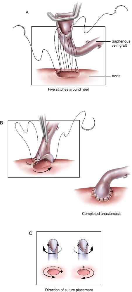 Figure 36-5, A Anastomosis of the saphenous vein to the aorta is usually performed after construction of the distal anastomosis to the coronary artery. We favor this technique and use a single period of aortic occlusion and intermittent retrograde perfusion of the myocardium via the coronary sinus for both distal and proximal anastomoses. Alternatively, some surgeons prefer to perform the proximal anastomosis as the initial step to ensure aortic input to the graft and to allow antegrade perfusion of cardioplegia solution through the graft via the aorta as the revascularization proceeds. The pericardial layer covering the aorta is removed over its anterior wall. Small openings (4 to 5 mm in diameter) are made into the ascending aorta using an aortic punch. The opening for the right coronary artery graft is directly anterior to or to the right lateral side of the aorta, whereas openings for left-side grafts are made on the left lateral side. The end of the saphenous vein is cut back longitudinally for a distance of approximately 1 cm. A Cooley infant vascular clamp is placed across the tip of the saphenous vein to flatten it for exposure of the vein’s shorter, beveled end. Five suture loops of 5/0 polypropylene are then placed around the heel of the graft and passed through the aortic wall. Two stitches are placed to the side of the apex, the third stitch is placed precisely through the apex of the incision in the saphenous vein, and the final two stitches are placed on the opposite side of the apex. Traction on both the suture and the vein graft helps expose the edge of the aortic opening for accurate needle placement. Stitches include about 3 to 5 mm of the aortic wall to ensure adequate strength of the anastomosis. B The suture loops are pulled up to approximate the vein graft to the aorta. The anastomosis is completed by placing stitches in a wagon-wheel fashion around the opening in the aorta. The placement of each stitch should be accurately visualized by observing the edge of the vein graft and the intima of the aorta. Retraction of the vein graft with forceps and slight relaxation of suture tension as the needle passes from the graft to the aorta provide exposure. Wide stitches are taken along the lateral edge of the saphenous vein as it is approximated with narrow stitches to the aorta to ensure that the maximal length of saphenous vein is positioned laterally. The completed anastomosis should bulge anteriorly above the aortic wall, achieving a “cobra head” appearance. C Left-side grafts are oriented so that the shorter, beveled end of the saphenous vein graft (the heel) directly faces the left side. The stitches are placed in a clockwise fashion around the heel of the graft and in a counterclockwise fashion around the aortic opening. The right coronary graft is placed so that the heel is oriented caudally; the stitches are placed in a counterclockwise fashion around the heel of the graft and in a clockwise fashion around the aorta.