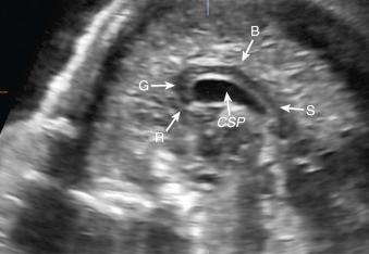 Fig. 34.1, Midsagittal (or median) plane of the brain in a 22-week fetus showing the entire corpus callosum. B, Body; CSP, cavum septi pellucidi; G, genu; R, rostrum; S, splenium.