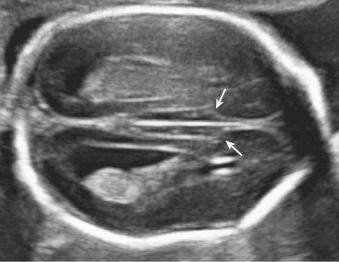 Fig. 34.4, Indirect signs of ACC. Axial scan of a 22-week fetal brain. Arrows indicate increased separation of the hemispheres with the bodies of the lateral ventricles parallel to each other and shifted laterally. Colpocephaly is also present.