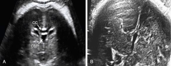 Fig. 34.5, (A) Midcoronal view of the brain in a 23-week normal fetus shows the normally developed frontal horns, genu (CC), and cavum septi pellucidi (CSP) . (B) ACC. Coronal scan of a 29-week fetal brain shows absence of the genu and increased distance between the frontal horns (arrows) . The inner walls of the frontal horns are concave medially because of the medial compression exerted by the Probst bundles. Together with the lumen of the third ventricle, this makes up the typical appearance of a “bull's head”.