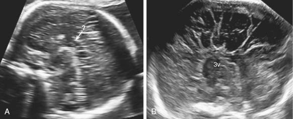 Fig. 34.6, (A) Midsagittal scan of the brain in a 22-week fetus with ACC shows the absence of the corpus callosum (?) and of the CSP. (B) ACC at 31 weeks' gestation. At this advanced gestational age, an atypical radiating appearance of the median sulci, which converge toward the third ventricle (3v), can also be seen.