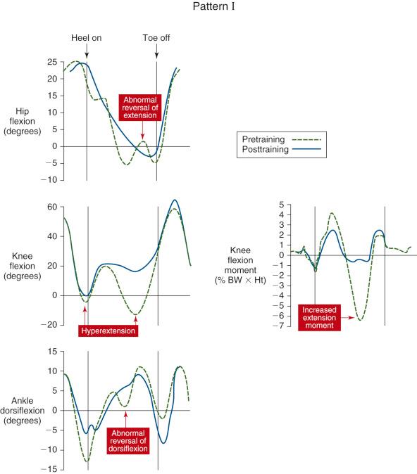 FIG 29-3, Generalized motion at the hip, knee, and ankle (in degrees), and flexion and extension moment (percentage of body weight × height) for patients showing pattern I, knee hyperextension at heel strike and midstance only. BW , Body weight; Ht , body height.