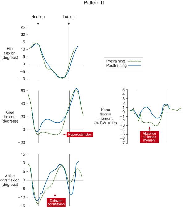 FIG 29-4, Generalized motion at the hip, knee, and ankle (in degrees), and flexion and extension moment (percentage of body weight × height) for patients showing pattern II, hyperextension of the knee throughout stance phase. BW , Body weight; Ht , body height.