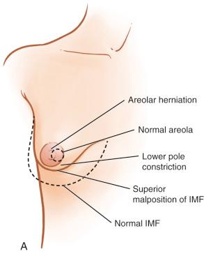 Fig. 24.2, Anatomical features of tuberous breast deformity. IMF, inframammary fold.