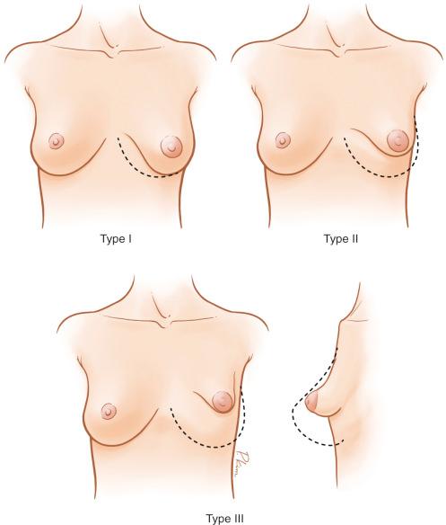 Fig. 24.4, Classification of tuberous breast deformity. Type 1, hypoplasia of the lower medial quadrant; type II, hypoplasia of the lower medial and lateral quadrants; and type III, severe breast constriction and global hypoplasia.