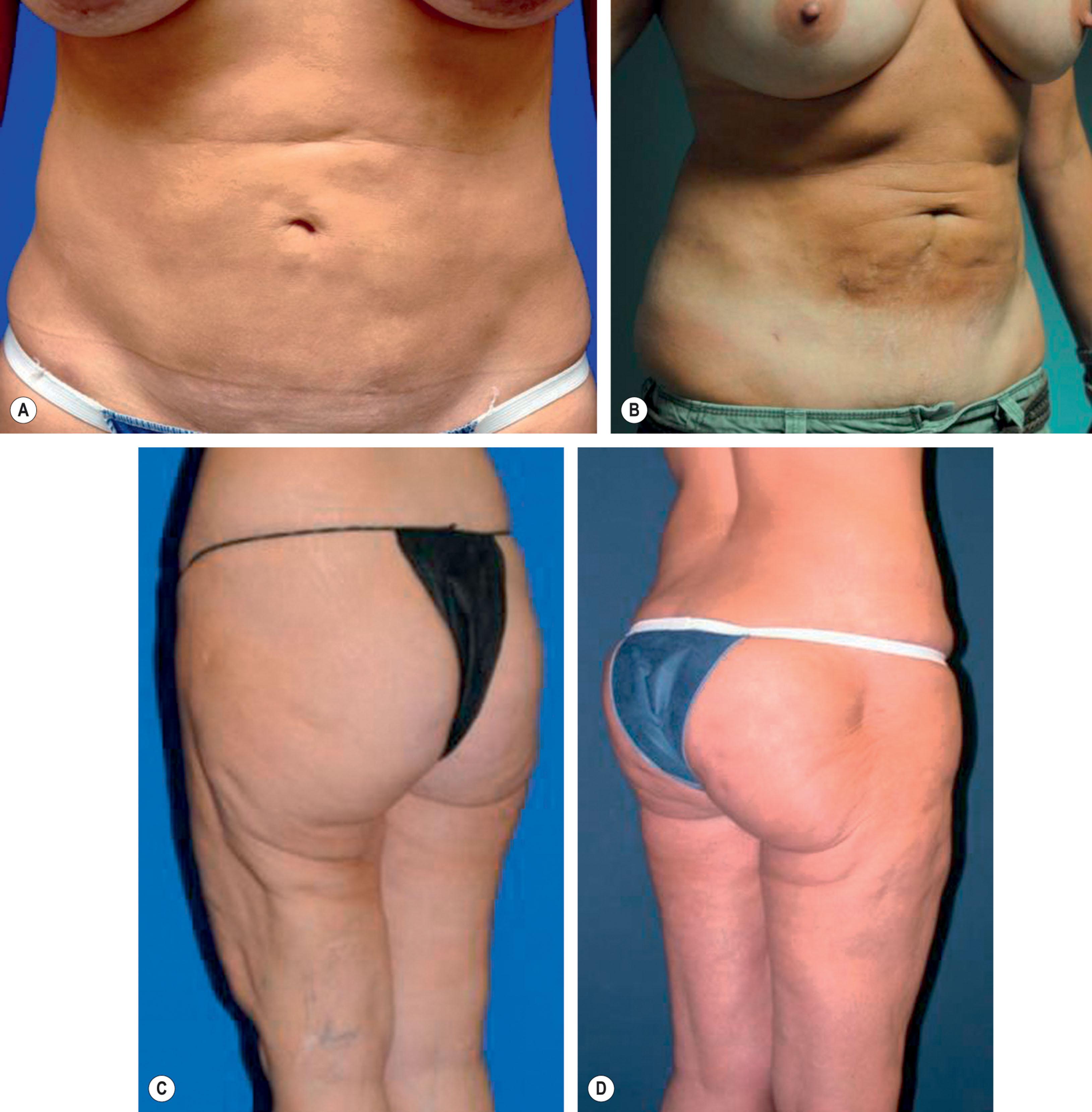 Figure 25.3.1, (A–D) Examples of contour deformities from liposuction.