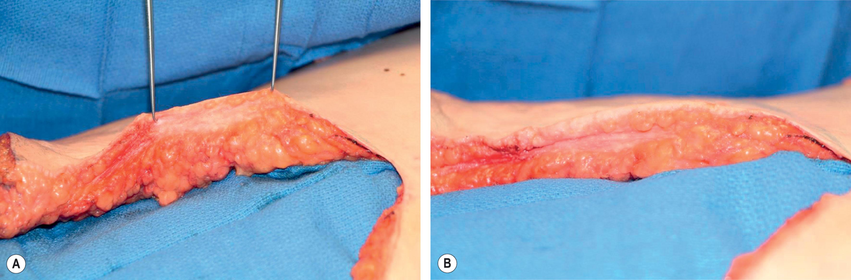 Figure 25.3.2, (A,B) Examples of fibrotic and scarred areas after thermal liposuction.