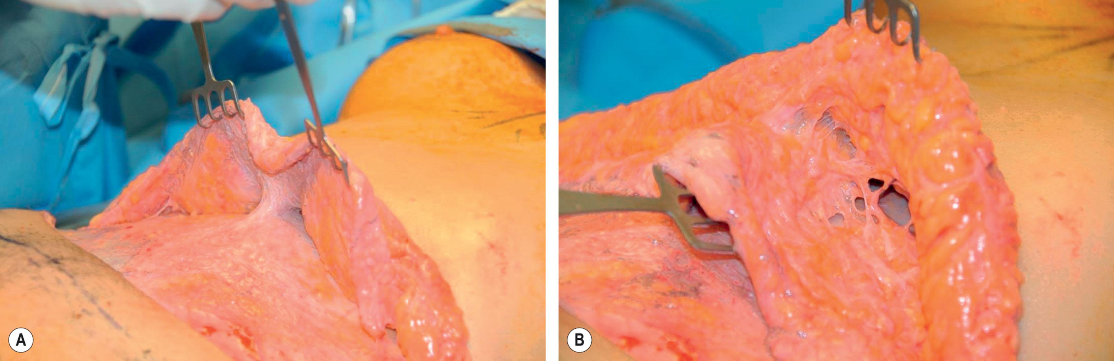 Figure 25.3.3, (A,B) Examples of extensive subcutaneous scar tissue after liposuction of the abdomen.