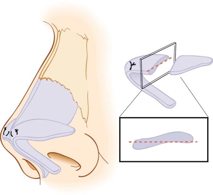 Figure 19-1, The caudal aspect of the lateral crus is situated ideally in the horizontal plane with the cephalic margin just superior to it.