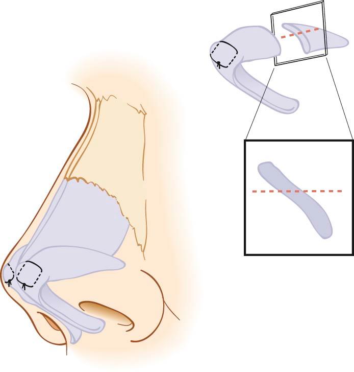 Figure 19-2, With a more vertical orientation of the lateral crus, the alar lobule is weaker and may further be weakened by cephalic rim excision, predisposing to a pinched tip appearance.