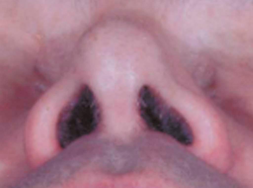 Figure 19-3, Typical “baby bottle teat” appearance of the pinched nasal tip.