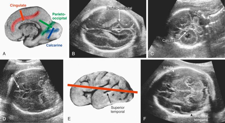 Fig. 36.1, US views used to show early-appearing sulci and fissures. (A) Medial hemispheric sulci at 26 weeks' gestation. Sulci indicated by color. Solid bars indicate scan orientation that is used to show each sulcus. 40 (B) Normal diamond-shaped appearance of parietooccipital fissure at 24 weeks' gestation (arrow) . (C) Calcarine fissure notch in medial occipital lobe at 22 weeks' gestation (arrow) . (D) Cingulate sulcus at 26 weeks' gestation (arrow) . (E) Early-appearing sulci on lateral brain surface at 28 weeks' gestation, and scan plane used to show sylvian fissure and insula (In) , and superior temporal sulcus. (F) Normal US appearance of early lateral sulci. White arrow points to angular plateau shape of insula; black arrow indicates superior temporal sulcus.