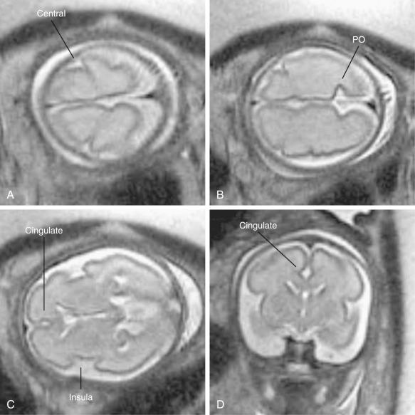 Fig. 36.2, MRI appearance of normal sulci in a 28-week fetus. (A) Central sulcus (this is very poorly seen with US). (B) Parietooccipital (PO) . (C) Cingulate sulcus and insula. Acute angles at margins of insula indicate normal operculization. (D) Cingulate sulcus. (E) Calcarine fissure. (F) Midsagittal view shows essentially straight brainstem and normal appearance of cerebellar vermis (CB vermis) , and triangular fourth ventricle. (G) Parasagittal view shows central sulcus and parietooccipital fissure (PO) , with calcarine fissure intersecting with it. (H) Normal triangular shape of insula and sylvian fissure.