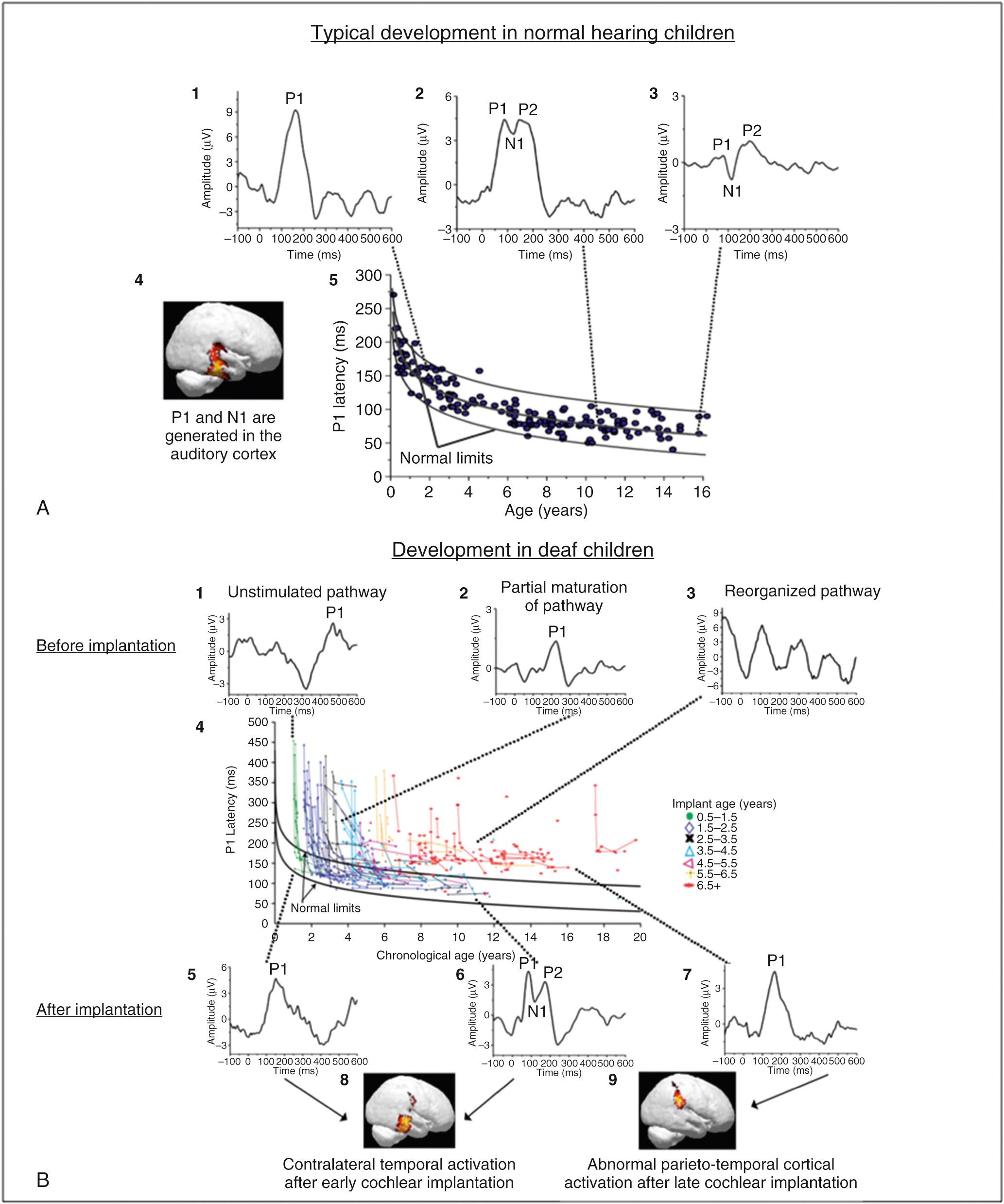 Fig. 132.1, Development of the central auditory pathways in normal hearing children and in deaf children receiving cochlear implants.