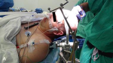 Figure 2.1, Anesthetic considerations. (A) Patient with a nasotracheal tube in sleep–awake–sleep procedure. (B) Light sedation with propofol. (C) Injection of local anesthetic at the pinning site. (D) Dural injection of local anesthetic around the neurovascular bundle.